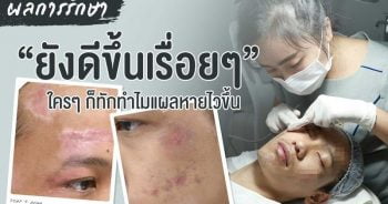 รักษารอยแผลเป็นที่หน้า