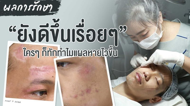 รักษารอยแผลเป็นที่หน้า