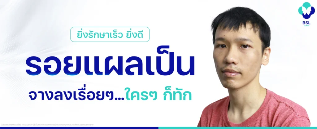 รอยแผลเป็นที่หน้า-จากอุบัติเหตุรถล้ม-รักษาด้วยอะไร-คนรู้จักทักแผลหายไว