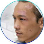 รอยแผลเป็นที่หน้า-จากอุบัติเหตุรถล้ม