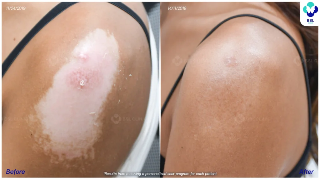 รีวิวรักษาแผลเป็น