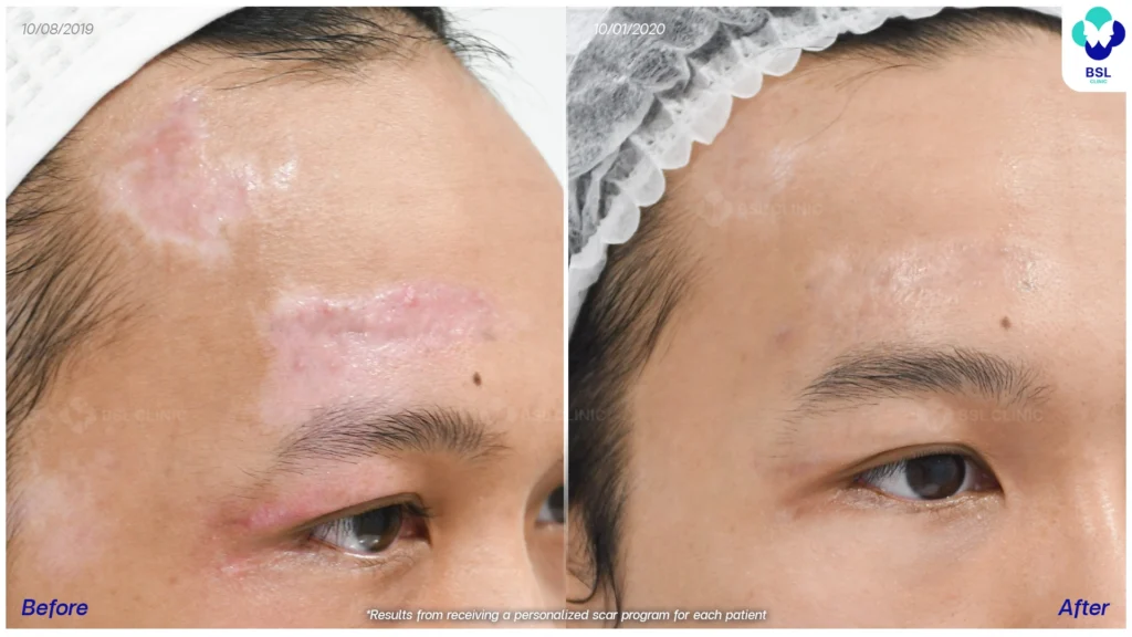 รีวิวรักษาแผลเป็น