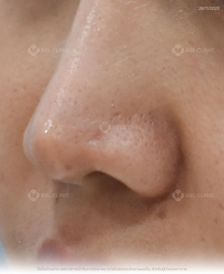 ผลการรักษาแผลเป็น-อุบัติเหตุ-แผลเป็นจมูก-After