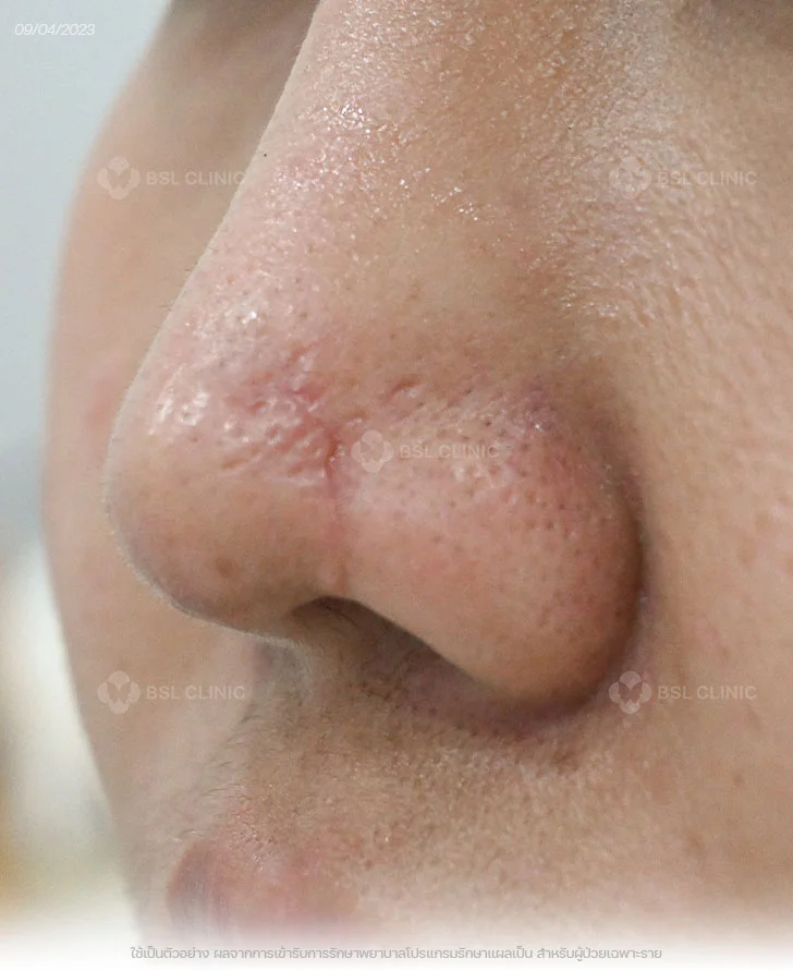 ผลการรักษาแผลเป็น-อุบัติเหตุ-แผลเป็นจมูก-Before